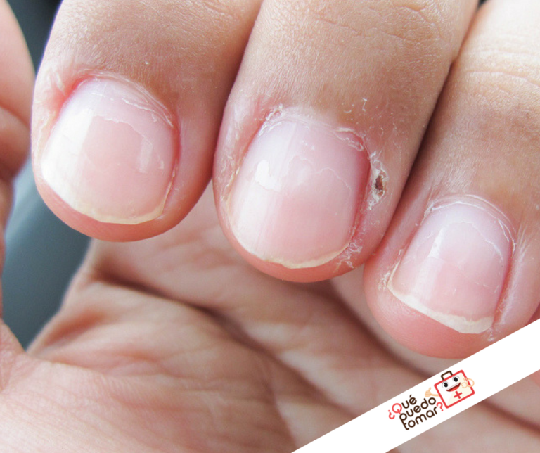 Hábito de morderse las uñas. Descubre qué hay detrás de esta costumbre