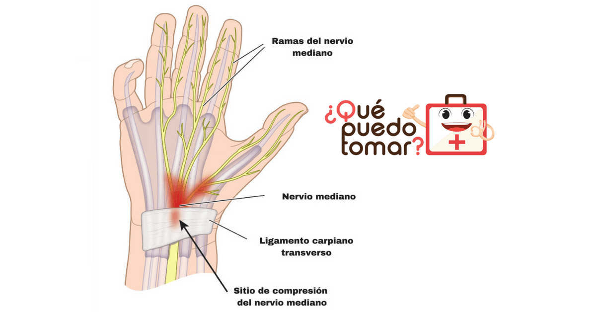 Síntomas de túnel carpiano