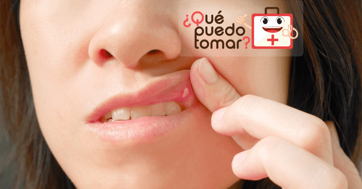 Aftas bucales